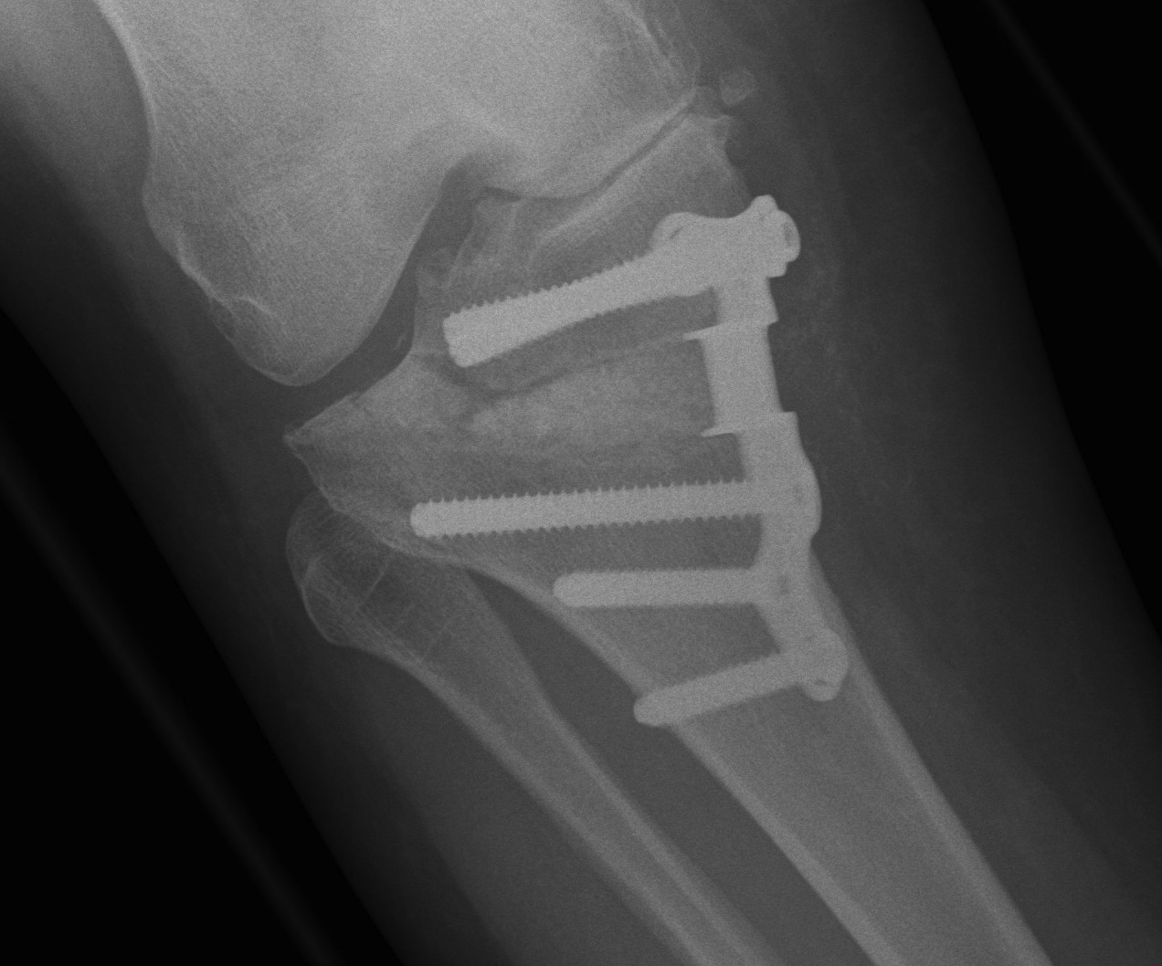 HTO Closing Wedge Intra-articular fracture